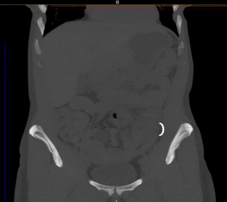 инородные 6